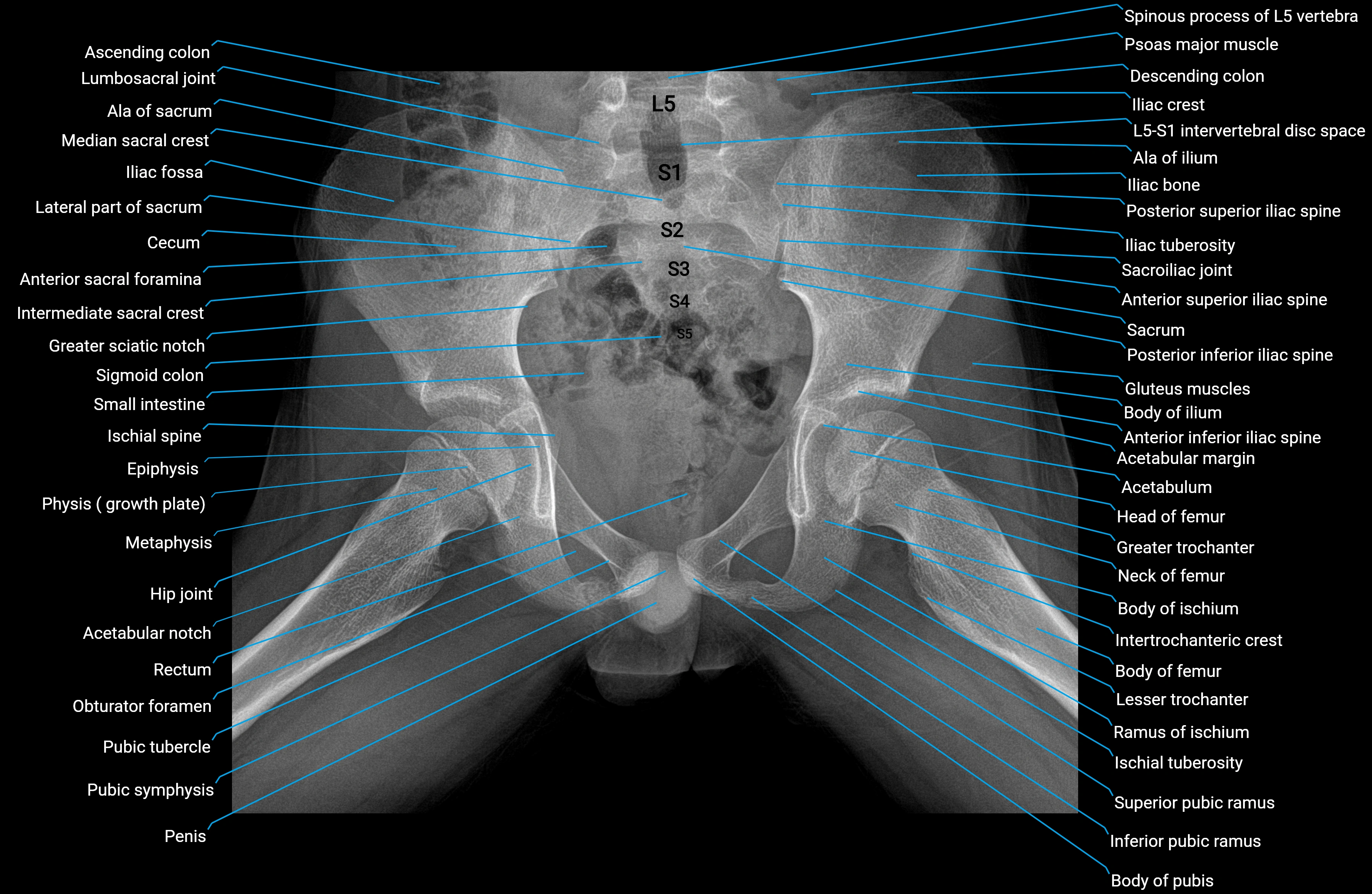 X ray pelvis  frog leg view  anatomy labelled image.webp